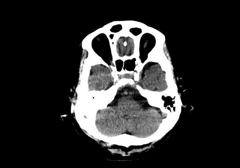 File:Anomalous intracranial venous drainage (Radiopaedia 28161-28418 Axial non-contrast 9).jpg