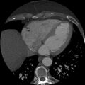 Anomalous origin of left circumflex artery from right coronary sinus (Radiopaedia 72563-83117 A 18).jpg