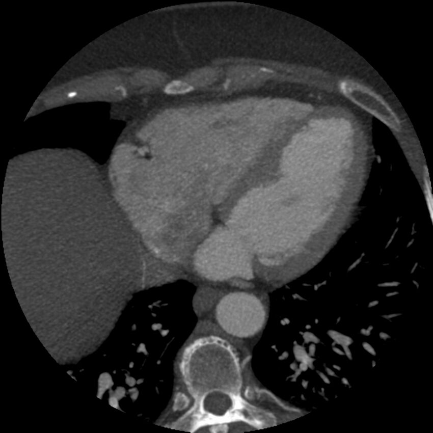 Anomalous origin of left circumflex artery from right coronary sinus (Radiopaedia 72563-83117 A 18).jpg