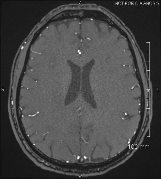 File:Anterior cerebral artery aneurysm (Radiopaedia 80683-94127 Axial MRA 159).jpg