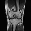 Anterior cruciate ligament full thickness tear (Radiopaedia 66268-75467 Coronal T1 12).jpg