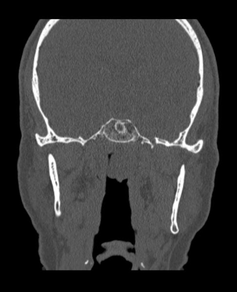 File:Antrochoanal polyp (Radiopaedia 79011-92169 Coronal bone window 7).jpg