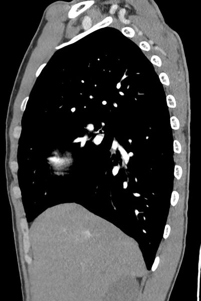 File:Aortic coarctation with aneurysm (Radiopaedia 74818-85828 B 49).jpg