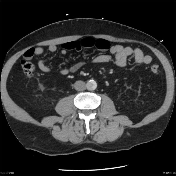 File:Aortic dissection- Stanford A (Radiopaedia 37759-39664 A 114).jpg
