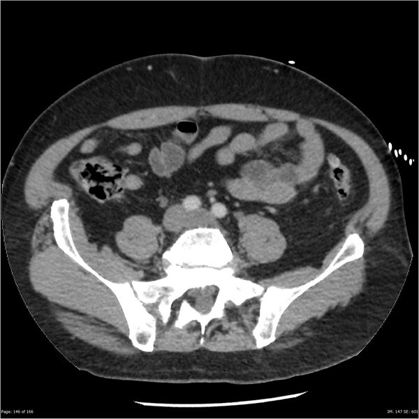 File:Aortic dissection- Stanford A (Radiopaedia 37759-39664 A 137).jpg