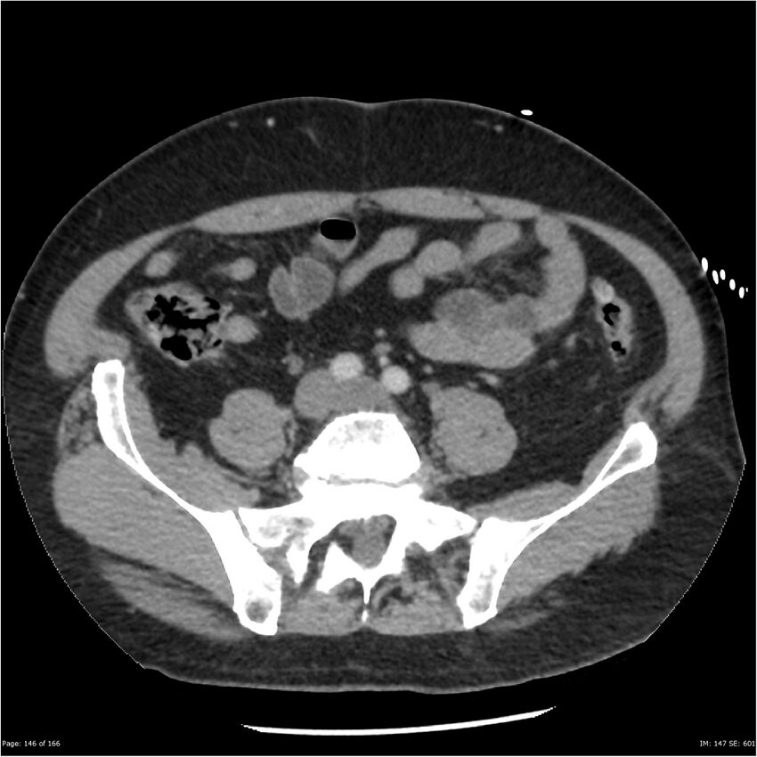 Aortic dissection- Stanford A (Radiopaedia 37759-39664 A 137).jpg