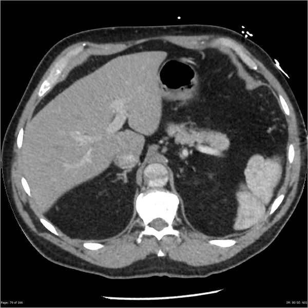 File:Aortic dissection- Stanford A (Radiopaedia 37759-39664 A 70).jpg