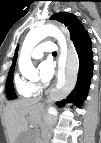 File:Aortic dissection - Stanford type B (Radiopaedia 50171-55512 C 26).png
