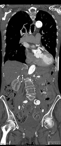 File:Aortic dissection with extension into aortic arch branches (Radiopaedia 64402-73204 A 38).jpg