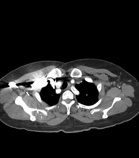 File:Aortic dissection with renal ischemia (Radiopaedia 76573-88338 A 7).jpg
