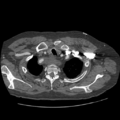 Aorto-coronary bypass graft aneurysms (Radiopaedia 40562-43157 A 18).png