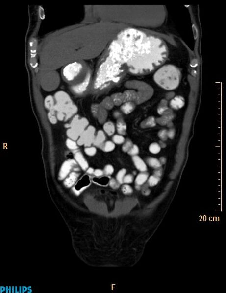 File:Appendiceal mucocoele (Radiopaedia 29449-29917 E 48).jpg