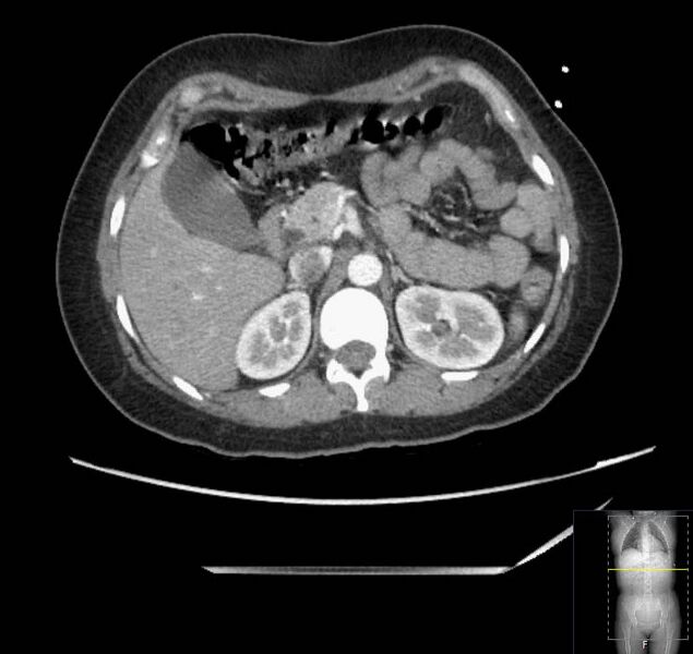 File:Appendicitis (CT angiogram) (Radiopaedia 154713-127660 Axial 141).jpg