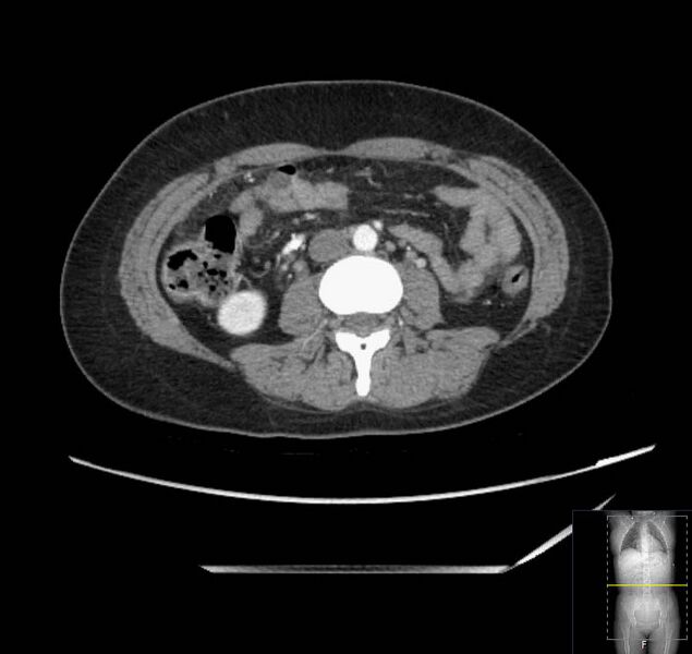 File:Appendicitis (CT angiogram) (Radiopaedia 154713-127660 Axial 75).jpg