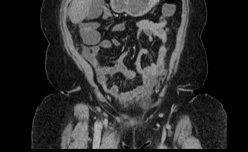 Appendix mucocele (Radiopaedia 41222-44033 B 12).jpg