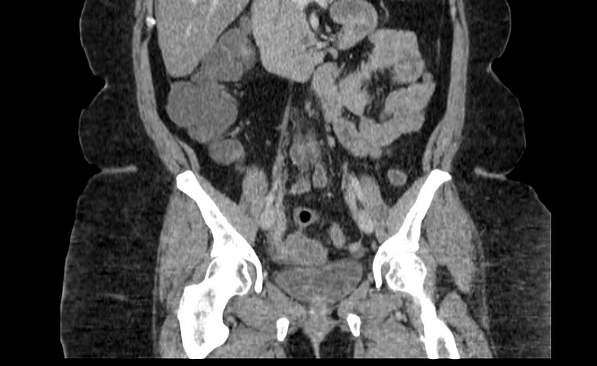 Appendix mucocele (Radiopaedia 41222-44033 B 41).jpg