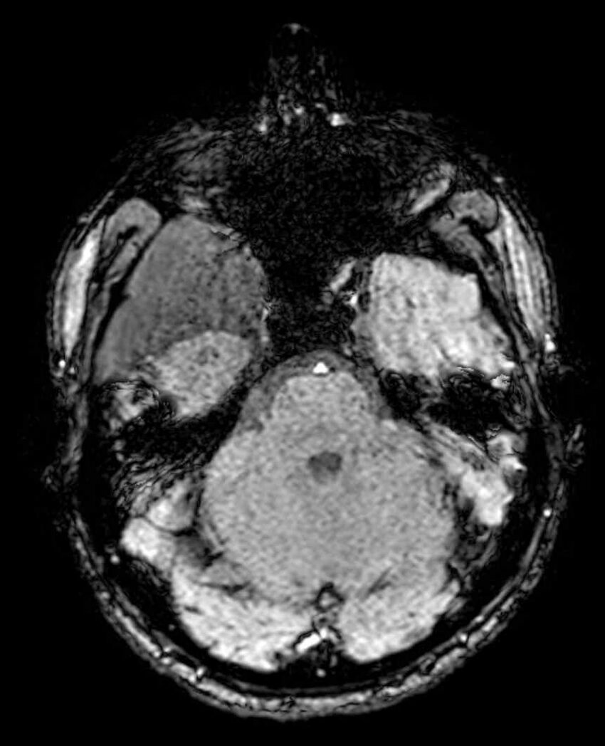 Arachnoid cyst- extremely large (Radiopaedia 68741-78451 Axial SWI 18).jpg
