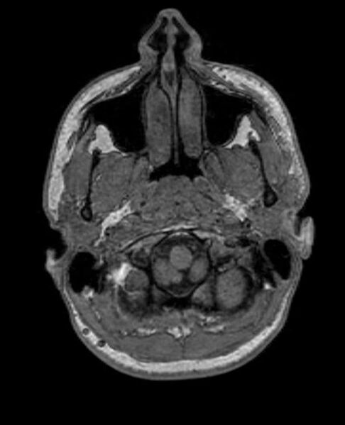 File:Arachnoid cyst- extremely large (Radiopaedia 68741-78451 Axial T1 9).jpg