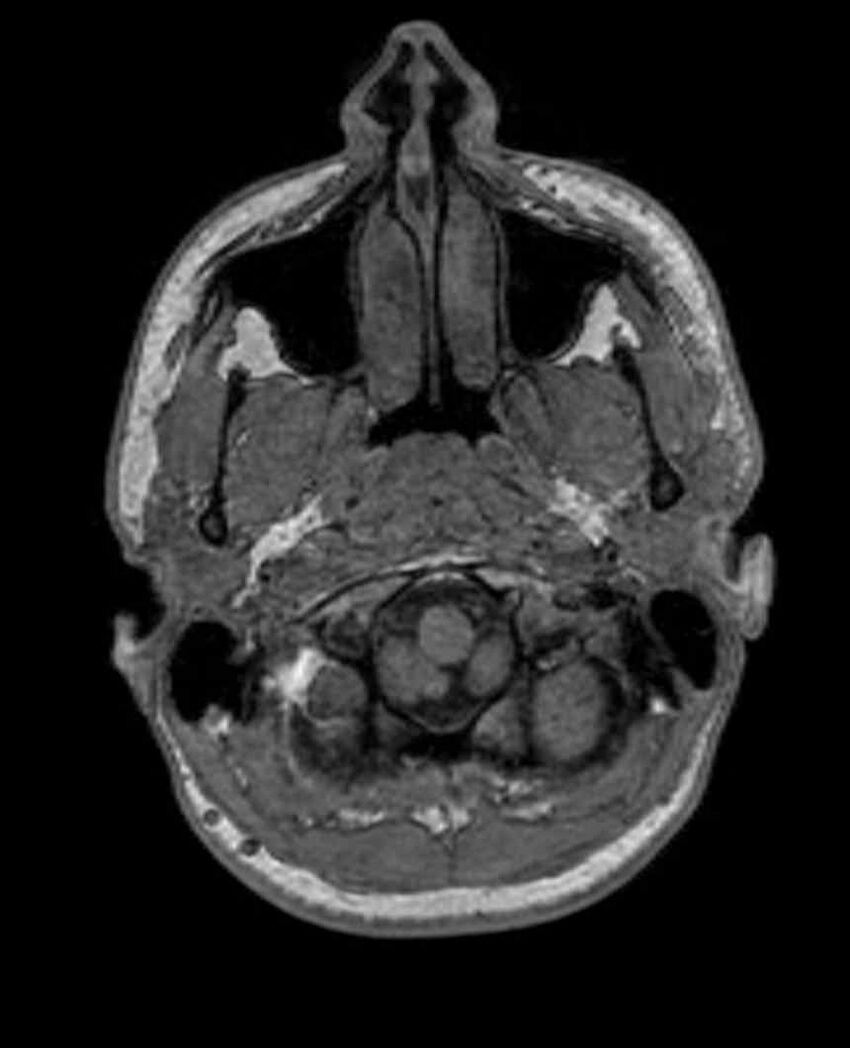 Arachnoid cyst- extremely large (Radiopaedia 68741-78451 Axial T1 9).jpg