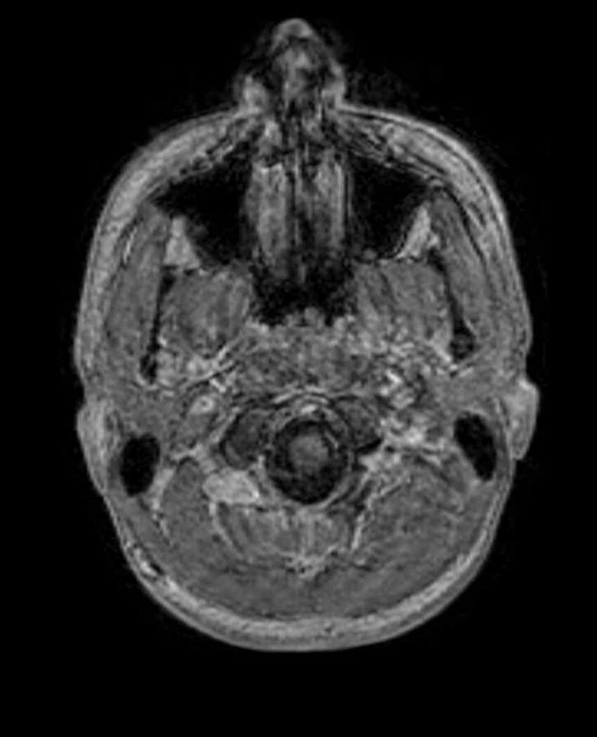 Arachnoid cyst- extremely large (Radiopaedia 68741-78451 Axial T1 C+ 9).jpg