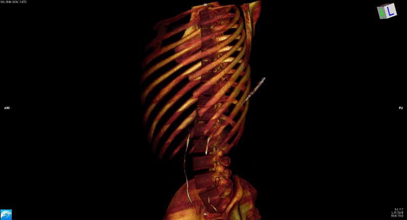File:Arrow injury to the chest (Radiopaedia 75223-86321 3D bone 9).jpg