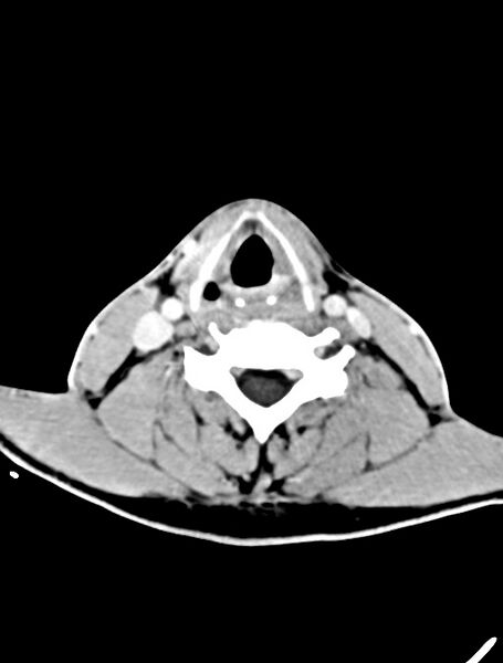 File:Arrow injury to the face (Radiopaedia 73267-84011 Axial C+ delayed 6).jpg