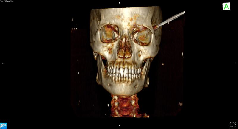 File:Arrow injury to the head (Radiopaedia 75266-86388 3D vertical 1).jpg