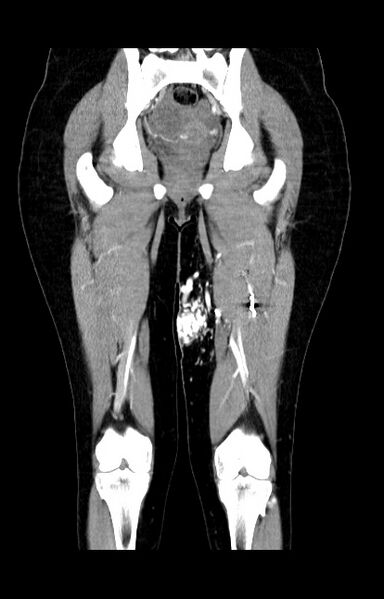 File:Arteriovenous malformation of the thigh (Radiopaedia 14948-14883 C+ arterial phase 14).jpg