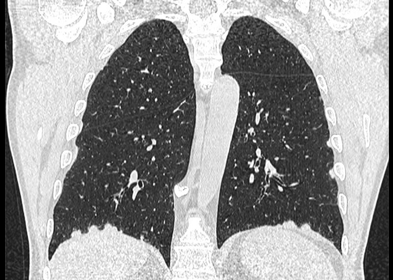 File:Asbestos pleural placques (Radiopaedia 57905-64872 Coronal lung window 201).jpg