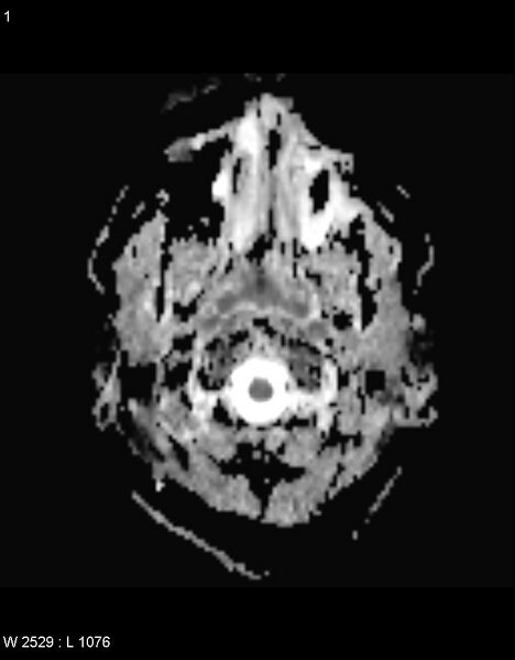 File:Astroblastoma (Radiopaedia 39792-42217 Axial ADC 19).jpg