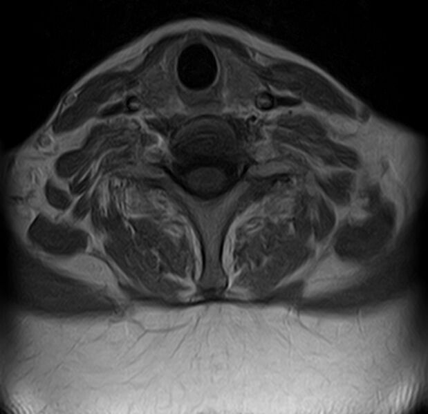 File:Astrocytoma - spinal cord (Radiopaedia 69769-79758 Axial T1 C+ 15).jpg