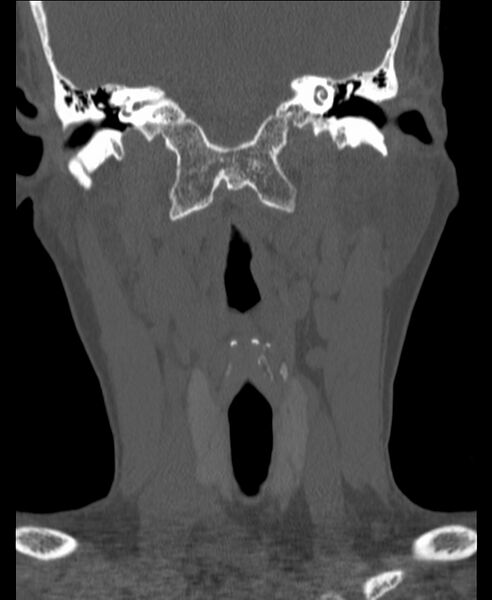 File:Atlanto-occipital assimilation with basilar invagination (Radiopaedia 70122-80188 Coronal bone window 44).jpg