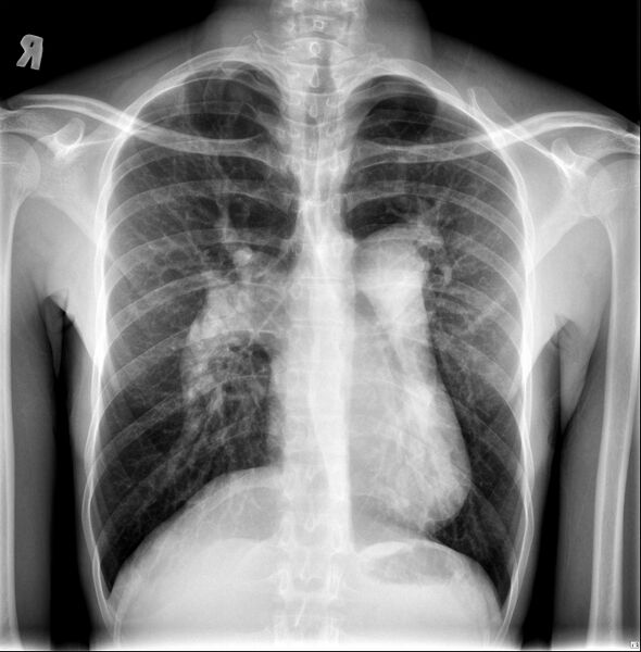 File:Atrial septal defect with pulmonary hypertension (Radiopaedia 48742-53788 Frontal 1).jpg