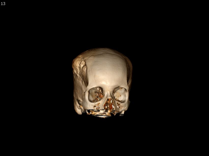 Atypical meningioma - intraosseous (Radiopaedia 64915-73867 3D volume render 13).jpg