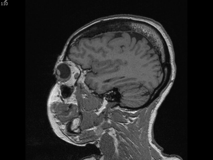 Atypical meningioma - intraosseous (Radiopaedia 64915-74572 Sagittal T1 110).jpg