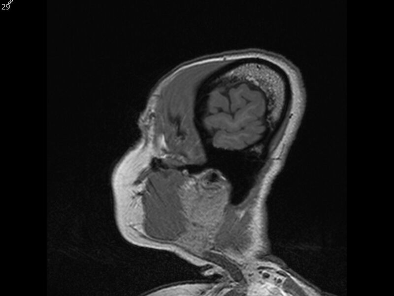 File:Atypical meningioma - intraosseous (Radiopaedia 64915-74572 Sagittal T1 29).jpg