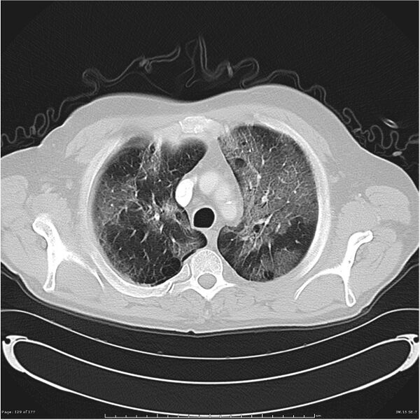 File:Atypical pneumonia - Q fever (Radiopaedia 21993-21989 lung window 8).jpg