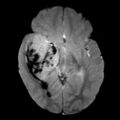 Atypical teratoid rhabdoid tumor (AT-RT) (Radiopaedia 6073-7553 Axial Gradient Echo 1).jpg