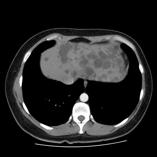 File:Autosomal dominant polycystic kidney disease (Radiopaedia 23061-23093 B 8).jpg