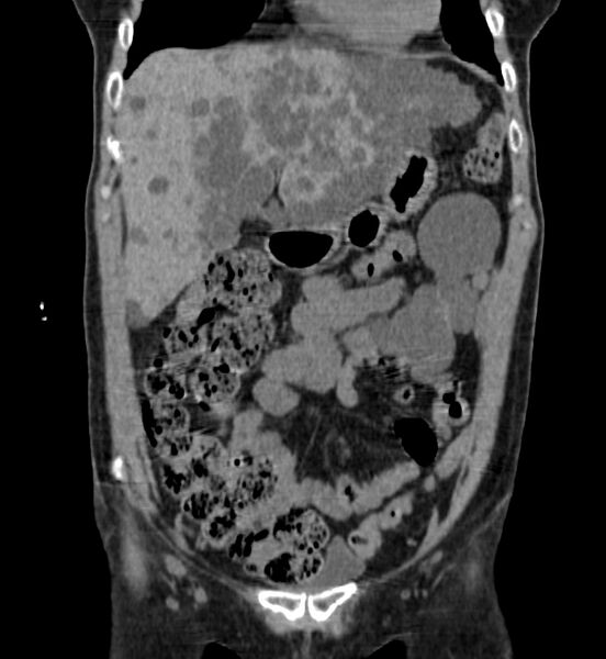 File:Autosomal dominant polycystic kidney disease (Radiopaedia 41918-44922 Coronal non-contrast 3).jpg
