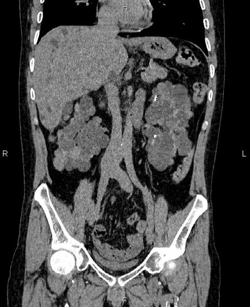 File:Autosomal dominant polycystic kidney disease (Radiopaedia 87830-104287 Coronal non-contrast 28).jpg