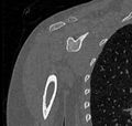 Avulsion fracture - greater tuberosity of humerus (Radiopaedia 71216-81514 Coronal bone window 37).jpg