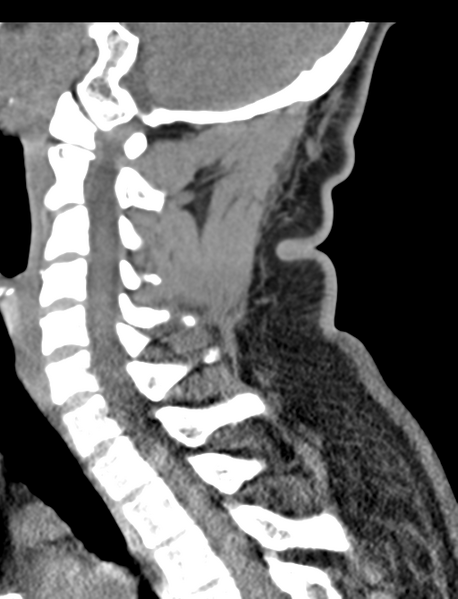 File:Axis peg fracture (type 3) and atlas lateral mass (type 4) fracture (Radiopaedia 37474-39324 D 42).png