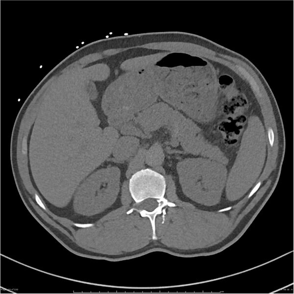 File:Azygos venous system anatomy (CT pulmonary angiography) (Radiopaedia 25928-26077 Axial C+ CTPA 99).jpg