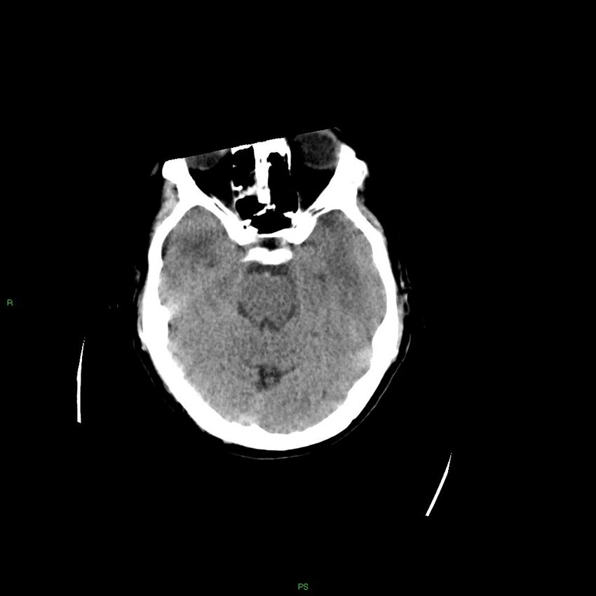 Basal ganglia hemorrhage (Radiopaedia 58349-65472 Axial non-contrast 39).jpg
