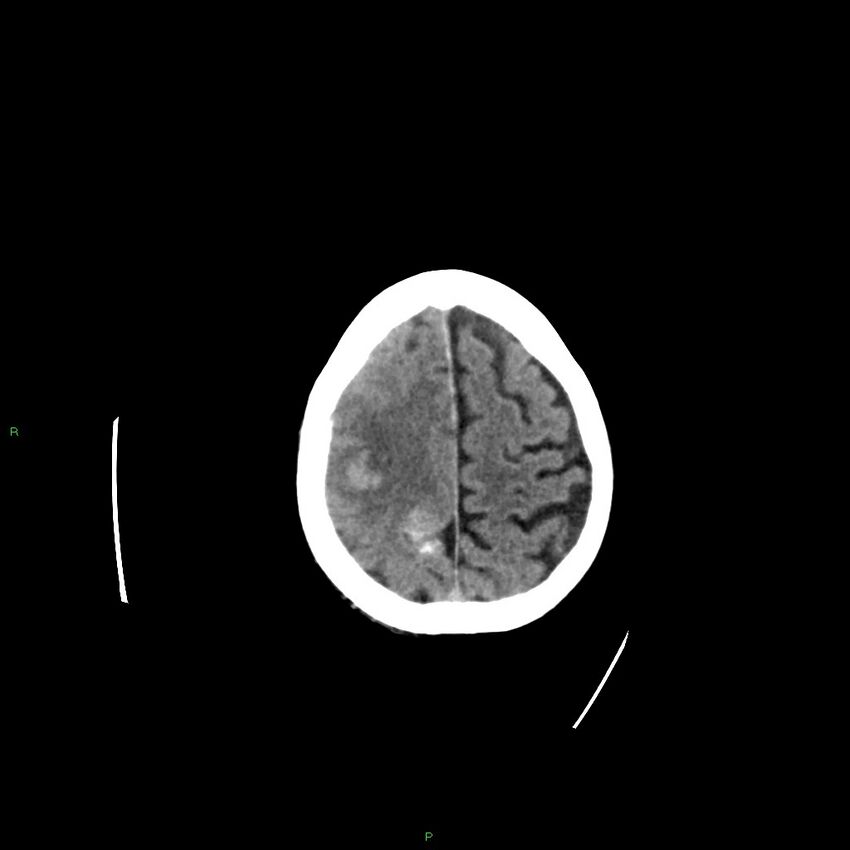 Basal ganglia hemorrhage (Radiopaedia 58350-65473 Axial non-contrast 11).jpg