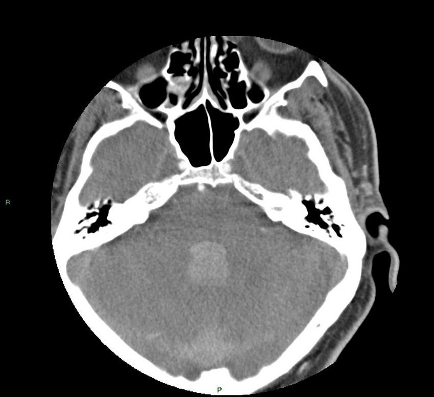 Basal ganglia hemorrhage (Radiopaedia 58763-65985 D 53).jpg