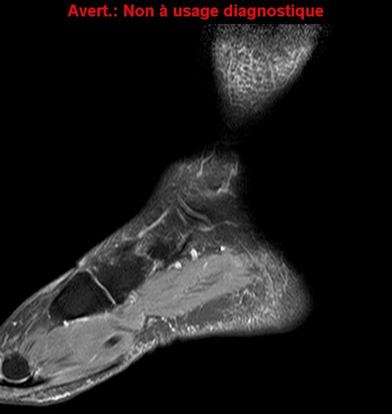 File:Baxter neuropathy (Radiopaedia 25988-26124 Sagittal T2 fat sat 4).jpg