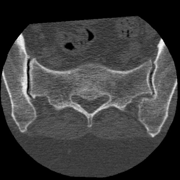 File:Bertolotti syndrome (Radiopaedia 24864-25128 Axial bone window 45).jpg