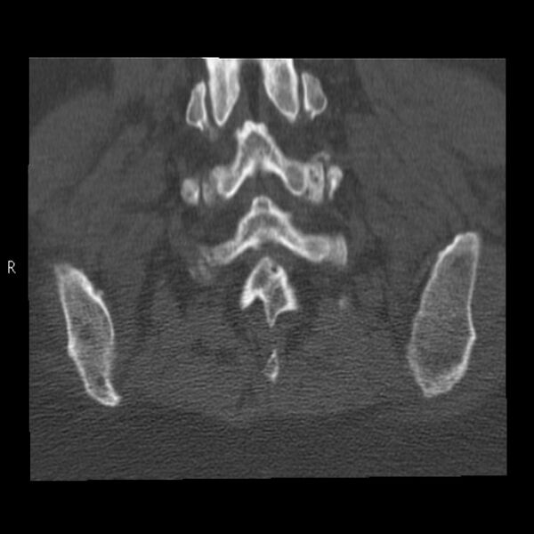 File:Bertolotti syndrome (Radiopaedia 24864-25128 Coronal bone window 41).jpg